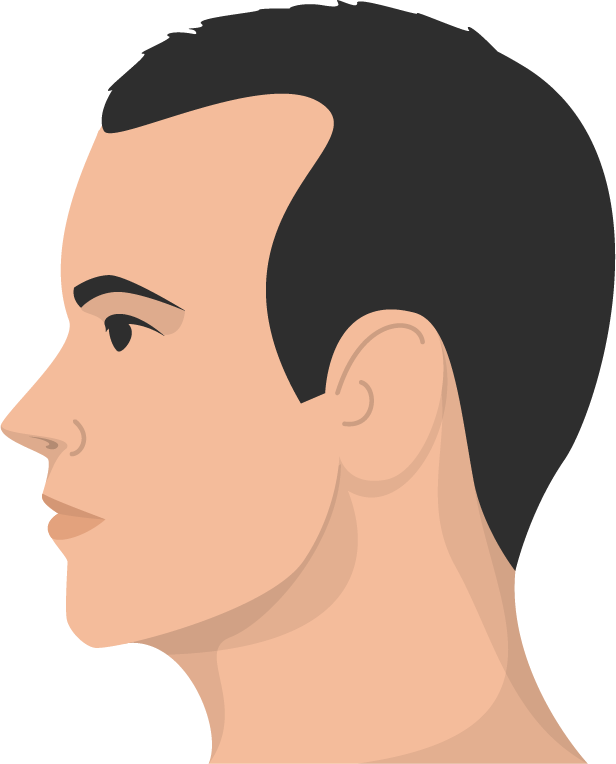 Haarausfall Muster 1