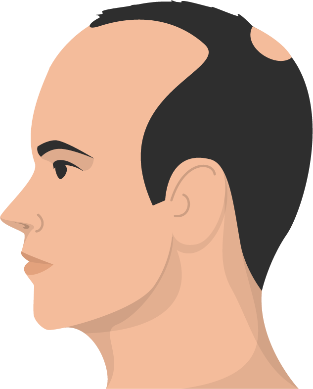 Haarausfall Muster 2