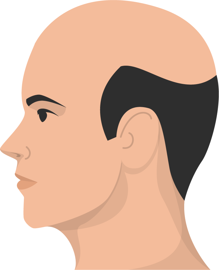 Haarausfall Muster 3